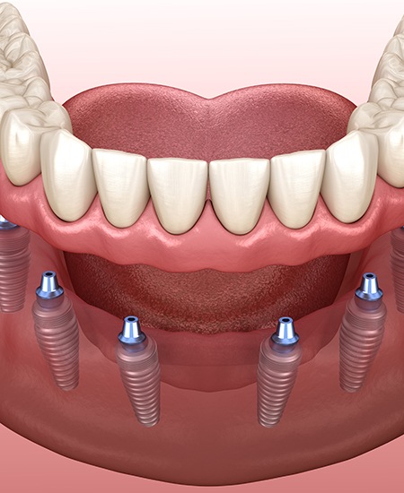 Image of implant dentures